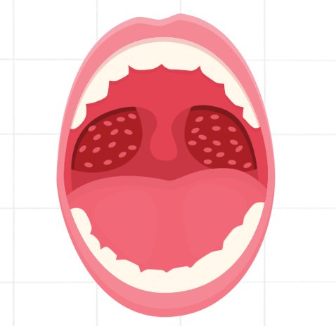 Amandelen in de keel