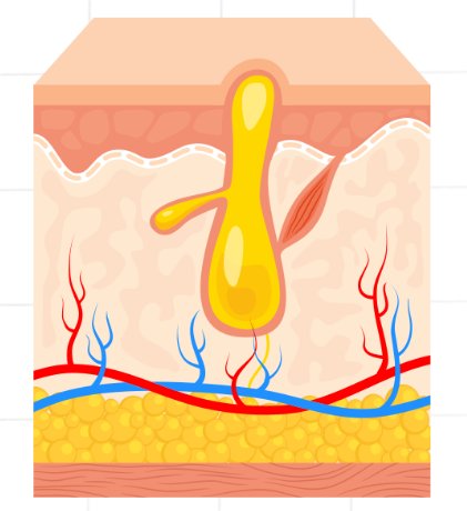 Acne en puisten op de menselijke huid